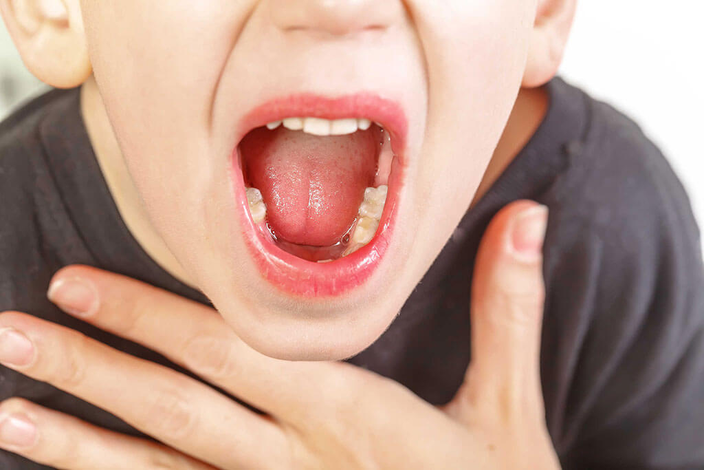 Viêm họng viêm thanh quản - các triệu chứng thường gặp 1
